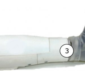 Une prothèse de bras qui décode les mouvements du membre fantôme