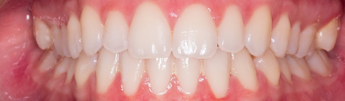 Medication to regrow enamel?