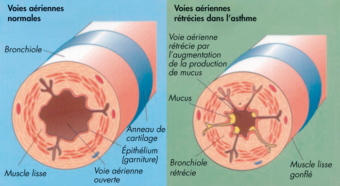 Bronchoconstriction