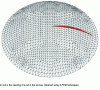 Figure 11 - Corneal surgery