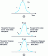 Figure 11 - Pulse distortion for DVG < 0