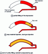 Figure 1 - Partial filling technique