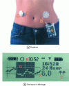 Figure 4 - MiniMed Paradigm® REAL-Time insulin pump and continuous glucose-monitoring system marketed by Medtronic, enabling glucose concentration to be measured in diabetic patients and regulated by insulin injection. The system comprises an insulin pump (A), an insulin delivery cannula (B), a sensor measuring glucose concentration (C) and a transducer (D). The system's display panel shows the evolution of glucose concentrations over time (according to [48]).