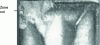 Figure 11 - Rapid degradation of the cutting face during activity A1