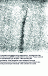 Figure 3 - Example of reheat cracking