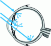 Figure 12 - Light diffuses into the lens, the vitreous humor and the retina, creating a veil of light that reduces visual contrast.