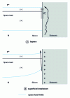 Figure 12 - Schematic representation of a junction termination subject to bypass or surface breakdown