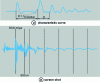 Figure 19 - Direct shock method: echograms