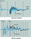 Figure 26 - Differential comparison method: superimposition of echograms on screen