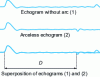 Figure 5 - Arc reflection: characteristic echograms