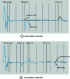 Figure 6 - Arc reflection: echogram screenshots