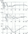 Figure 14 - Evolution of voltage, current and magnetic induction in the transformer during line discharge: example