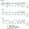 Figure 21 - Ferroresonance of a magnetic voltage transformer when the circuit breaker opens: example