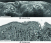 Figure 15 - Comparison of a melanoma image obtained in vivo by LC-OCT and a histology image (from J. Biomed. Opt. 23, 106007 (2018))