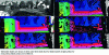 Figure 10 - Comparison of stereovision methods on a pair of images from a vehicle-mounted stereoscopic system (data: www.cvlibs.net/datasets/kitti/, comparison performed by M. Derome, ONERA, 2014)