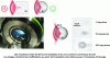 Figure 7 - Illustration of the refractive index change inside a silicon bead (after [12])