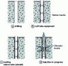 Figure 21 - Cuff-tube injection