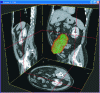 Figure 4 - Automatic 3D segmentation of a kidney and display of contour control points