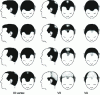 Figure 6 - Norwood-Hamilton scale for assessing the stage of androgenetic alopecia in men