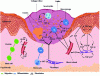 Figure 3 - Inflammatory phase [19]