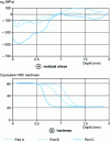 Figure 43 - Residual stress and hardness distribution profiles in a SAE 1552 steel pinion tooth after localized hardening following induction heating [2]