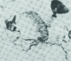 Figure 5 - Destabilization ranges with pearlitic facies and areas of incomplete solution formation: temperature holding stage too short, insufficient cooling rate, very massive part (x 150)