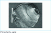 Figure 34 - Bending and tension-compression fatigue failure of a ∅ 350 mm horizontal piston from a gas blower. Rough final fracture