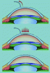 Figure 10 - How LASIK corneal refractive surgery works