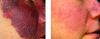 Figure 12 - Treatment of a plane angioma with a pulsed dye laser (author's collection or © Serge Mordon)