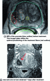 Figure 15 - (a): MRI of the prostate (blue outline) before treatment. (b): necrosis (red arrow) obtained 7 days after treatment (author's collection or © Serge Mordon).