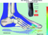 Figure 16 - Pain-relieving forefoot stepping zones to escape ulcerated heel pain