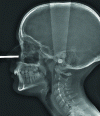 Figure 16 - Static cranial profile incidence. Today, 2D profile teleradiography is still the reference image used by orthodontists for initial and follow-up treatment planning. It is the extra-oral incidence that best respects Fitzgerald's rule of finesse, guaranteeing minimal image distortion. The right and left mandibular bases are practically superimposed, as are the roof of the orbits and the large wings of the sphenoid.