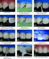 Figure 31 - Steps in direct restoration of a fractured anterior tooth (source of illustrations [16])