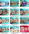 Figure 32 - Steps in direct restoration of decayed posterior teeth (source of illustrations [16])