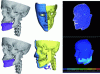 Figure 7 - Bone repositioning schedule (left) and corresponding simulation: mandibular recoil boundary conditions (center) provide a FE calculation with relative displacements (right) (Photo credits: Laboratoire TIMC-IMAG &CHU de Toulouse)