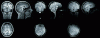 Figure 1 - MRI sections of adult brain. From left to right: T1-weighted, T2-weighted and proton density-weighted MRI (© F. Rousseau, ICube, 2013).