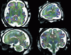Figure 10 - Visualization of estimated principal diffusion directions from antenatal diffusion MRI images (© F. Rousseau, ICube, 2013).