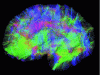 Figure 11 - Visualization of a tractogram estimated from antenatal diffusion MRI images. Fibers are locally colored according to their direction in 3D space (© F. Rousseau, ICube, 2013)