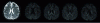 Figure 3 - Axial sections of diffusion images in adults. From left to right: image b = 0, then four diffusion-weighted images (with b = 1,200 s · mm2) along four spatial directions (© F. Rousseau, ICube, 2013)