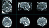 Figure 4 - Triplanar visualization (axial, sagittal, coronal) of a low-resolution fetal MRI image (top) and corresponding 3D reconstruction (bottom) (© F. Rousseau, ICube, 2013)