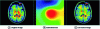 Figure 5 - Illustration of intensity bias on an axial section of a T1-weighted image(© F. Rousseau, ICube, 2013).