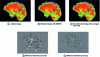 Figure 7 - Illustration of noise reduction techniques. A noise reduction technique is all the more effective when the difference image is similar to a pure noise image (© F. Rousseau, ICube, 2013)