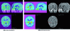Figure 10 - Visualization of re-aligned images (MRI – PET)