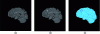 Figure 12 - Detecting the evolution of multiple sclerosis (MS) lesions in temporal image sequences: (a) and (b) represent two FLAIR MRI images acquired six months apart of an MS patient, (c) corresponds to the Jacobian map of the non-rigid transformation estimated when image (b) is registered on image (a): high Jacobian values highlight lesion evolution.