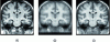 Figure 13 - Construction of an average brain image by registering 18 morphological MRIs on the image (a) with an affine registration method (b) and a deformable registration method (c).