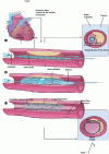 Figure 12 - Stent insertion during angioplasty (Image: Wikipedia)