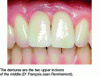 Figure 11 - Dentures among natural teeth (from [5])