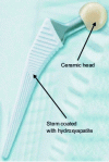 Figure 12 - Hip prosthesis (based on [N4950])