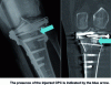 Figure 6 - Postoperative image (tibial plateau fracture) (Dr Sébastien Parratte, Hôpital Ste Marguerite, APHM)