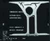 Figure 24 - Defects on an organic matrix composite part (doc. Hispano Suiza, COFREND collaboration)